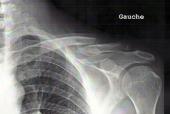 Collarbone