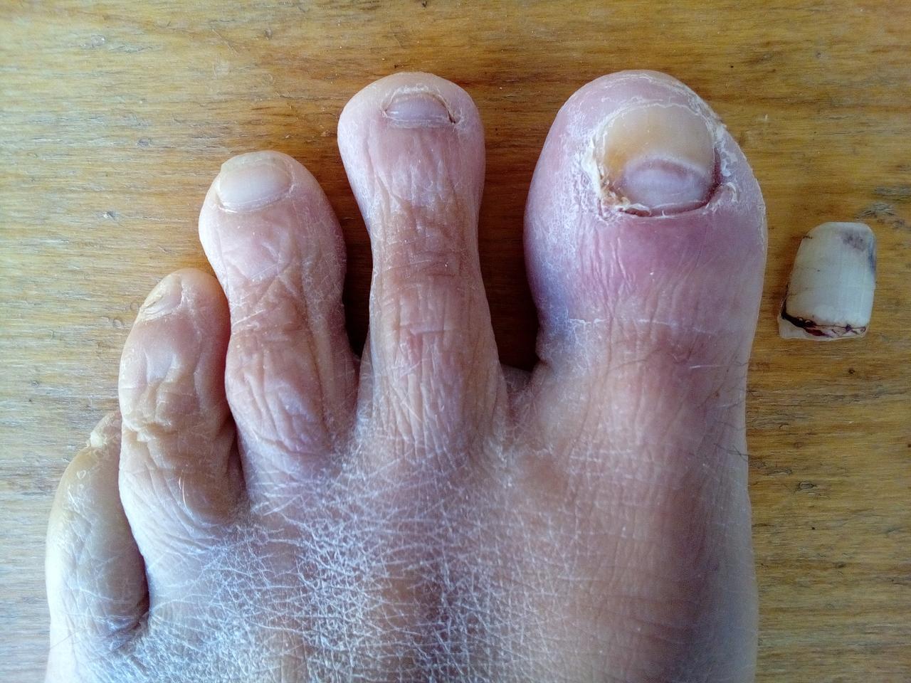 What happend to my toe nail?!